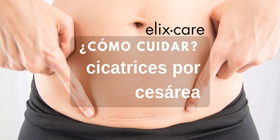 Cómo cuidar cicatrices de cesárea